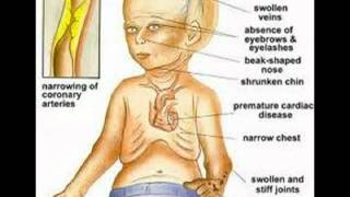 Progeria Awareness