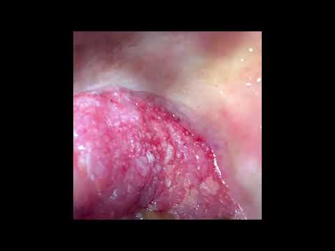 Wedge Or Incisional Biopsy Of A Growth In The Palatal Aspect Of The Gums