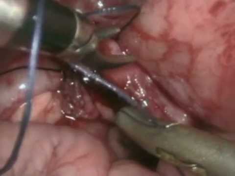 Laparoscopic Pull Thru for High Imperforate Anus (Child born without anus)