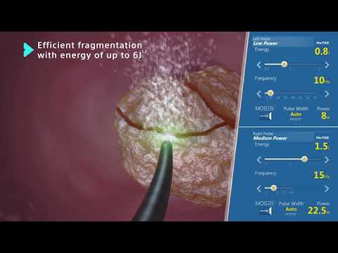 MOSES™ 2.0 Technology: Holmium Laser for Lithotripsy Animation