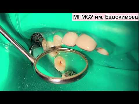 Лечение пульпита временного однокорневого зуба методом пульпотомии с использованием препарата МТА