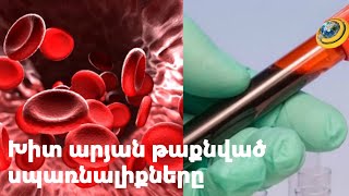 Խիտ արյան թաքնված սպառնալիքները