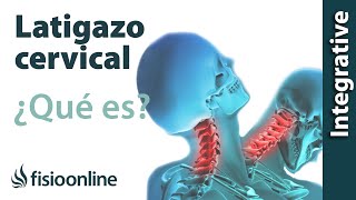 Latigazo cervical - ¿Qué es y cuáles son las claves de su solución