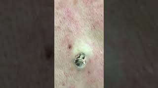 MASSIVE Blackhead Popped Out!! #DrPimplePopperThisIsZit #Shorts