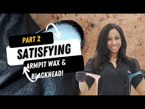 A armpit wax & Blackhead Part 2