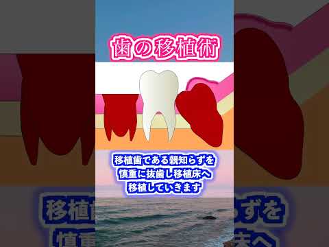 生命歯学科 歯周外科手術　歯の移植法について解説します！　#shorts  #歯周外科　＃歯周病　＃歯を抜かない　＃歯を残す  #dentist #再生療法 #歯を抜かない #歯科 #口腔外科　#歯牙レプリカ