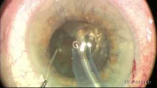 Small pupil, dense black cataract surgery Ike Ahmed