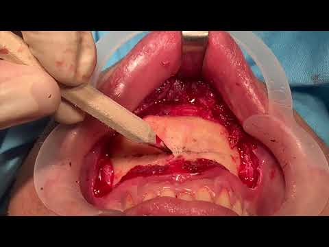 Genioplasty To Remove Double Chin, Improve Ratios