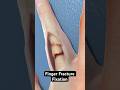 Fixing a fractured finger (3D Animation) - Viz Medical Fixing a fractured finger (3D Animation)