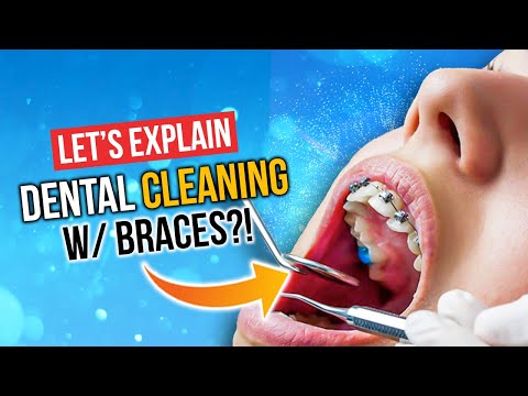 Dental CLEANING With BRACES!