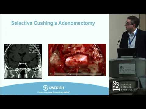Medical and Surgical Management of Pituitary Tumors - Zachary N. Litvack, MD, MCR, FAANS