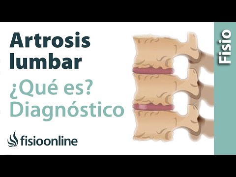 lumbosacral artrosis kezelése