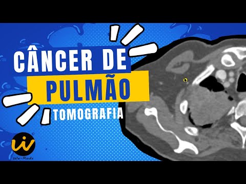 Lung Cancer in the Apex of the Lung - Chest Computed Tomography