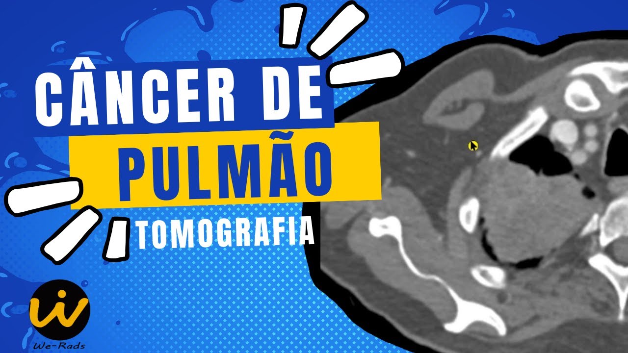 CÂNCER de PULMÃO no Ápice Pulmonar - Tomografia Computadorizada de TÓRAX