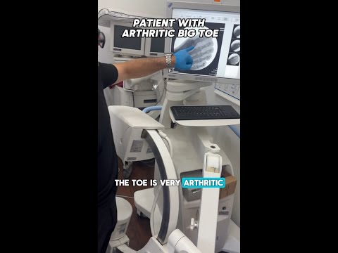 Arthritic big toe? We can help!