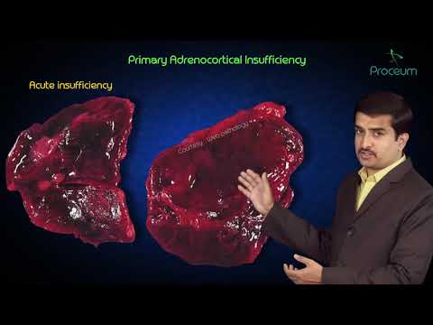 Primary Adrenocortical Insufficiency / Addisons disease - Endocrine pathology