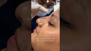 "Nose Hump Fix in Minutes: Non-Surgical Rhinoplasty at Cara Clinic Mum