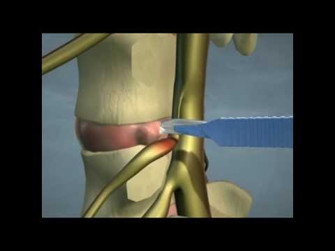 Complicații ale durerilor de artroplastie articulară