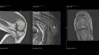 Dislocated meniscus and knee locked in flexion