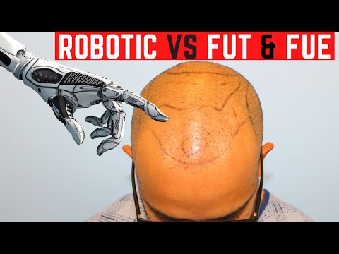 Robotic hair transplant before and after