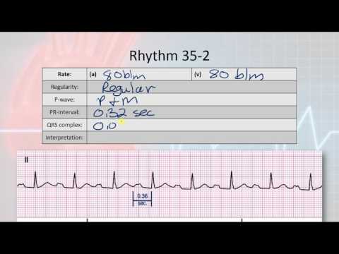 Basic Electropysiology, part 10 - AV Heart Block Rhythms
