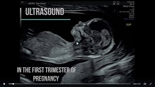 Diagnostic Ultrasound in the First Trimester -  scanning basics & new screening modalities