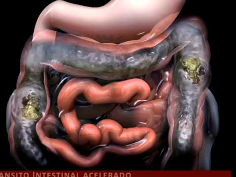 Sindrome de intestino irritable cie 10