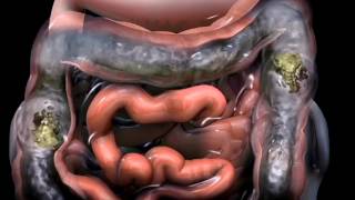 Dolor pélvico por síndrome de intestino irritable