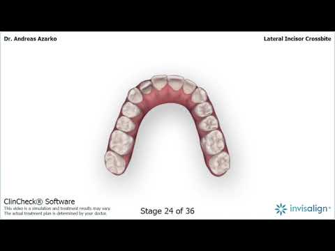 Azarko Dental Edmonton Teeth Tucked Behind CSD