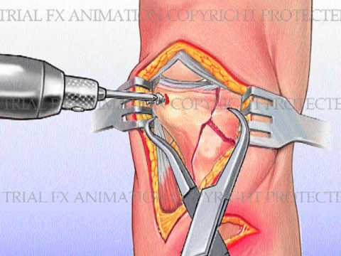 Knee Replacement ist eine Behinderung Ischias Symptome einer degenerativen Bandscheibenerkrankungen Exazerbation