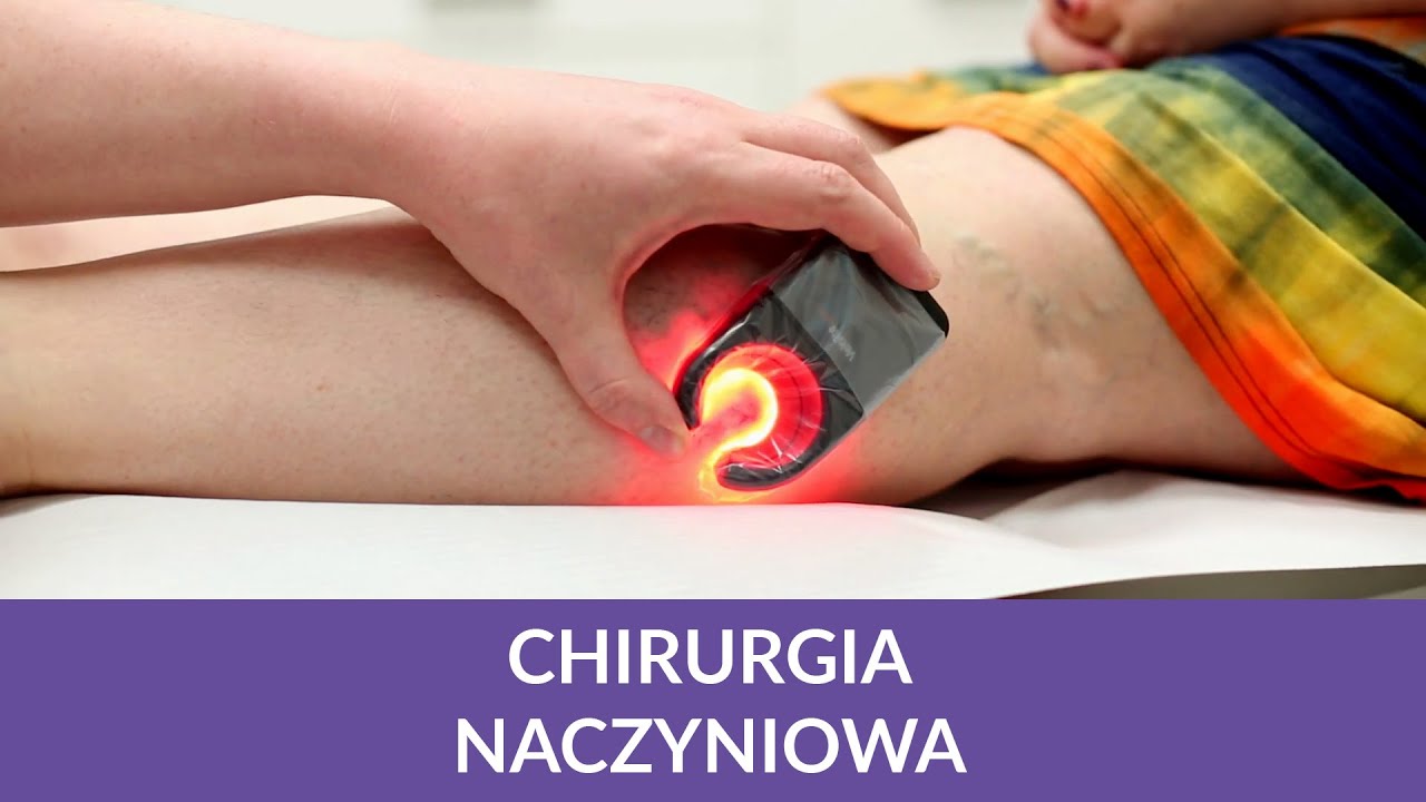 Żylaki i pajączki na nogach (usuwanie) Chirurgia naczyniowa