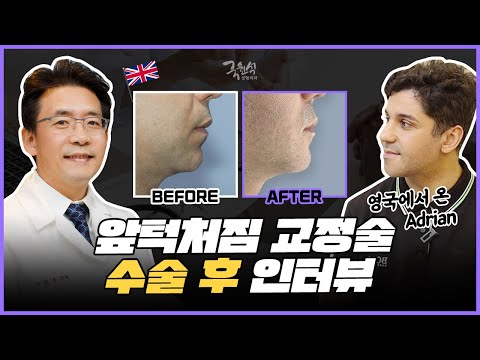 영국에서온 adrian, 앞턱처짐 교정 수술 후 솔직한 인터뷰!