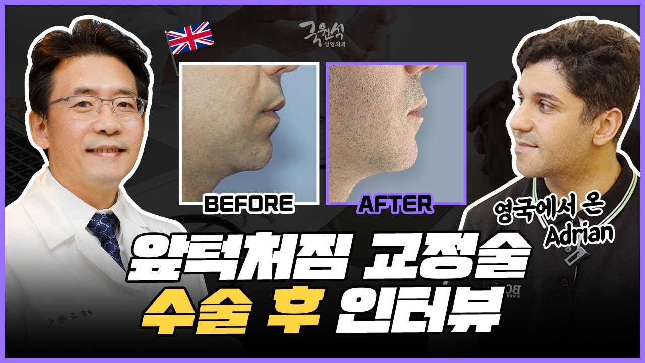 영국에서온 adrian, 앞턱처짐 교정 수술 후 솔직한 인터뷰!