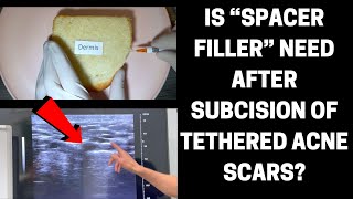 Is “Spacer Filler” Needed After Subcision Of Tethered Acne Scars?