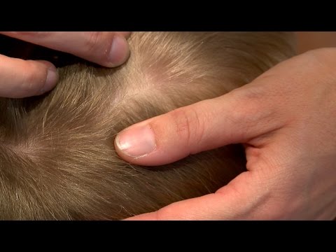 Tipps zur Läusebekämpfung