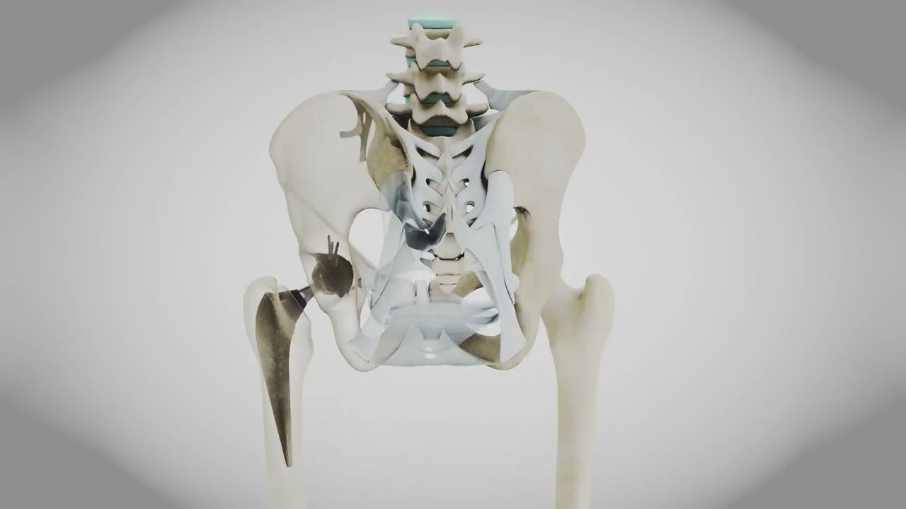 Replaced Hip Implant 3D Model