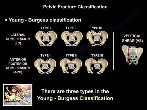 Pelvic Fractures - Everything You Need To Know - Dr. Nabil Ebraheim