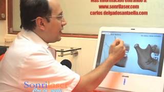 Las Cordales o Muelas del juicio, edad para extraerlas