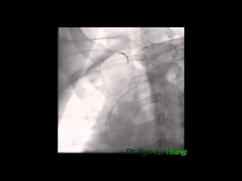 Completely Retrograde Wiring Technique in CTO intervention