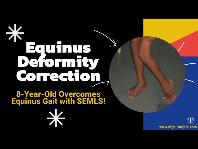 Cerebral Palsy Treatment Video 4