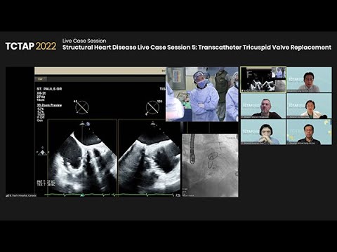 [TCAP 2022] Structural Heart Disease Live Case Session 5: Transcatheter Tricuspid Valve Replacement
