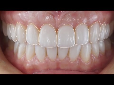 Лечение стираемости зубов. Реставрация зубов по силиконовому ключу