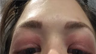 how to get rid of allergic reaction on eyelid