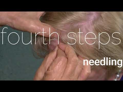 DEMO YNSA Yamamoto New Scalp Acupuncture Oskar Ausserer ZDN