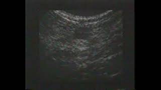breast ultrasonograp
