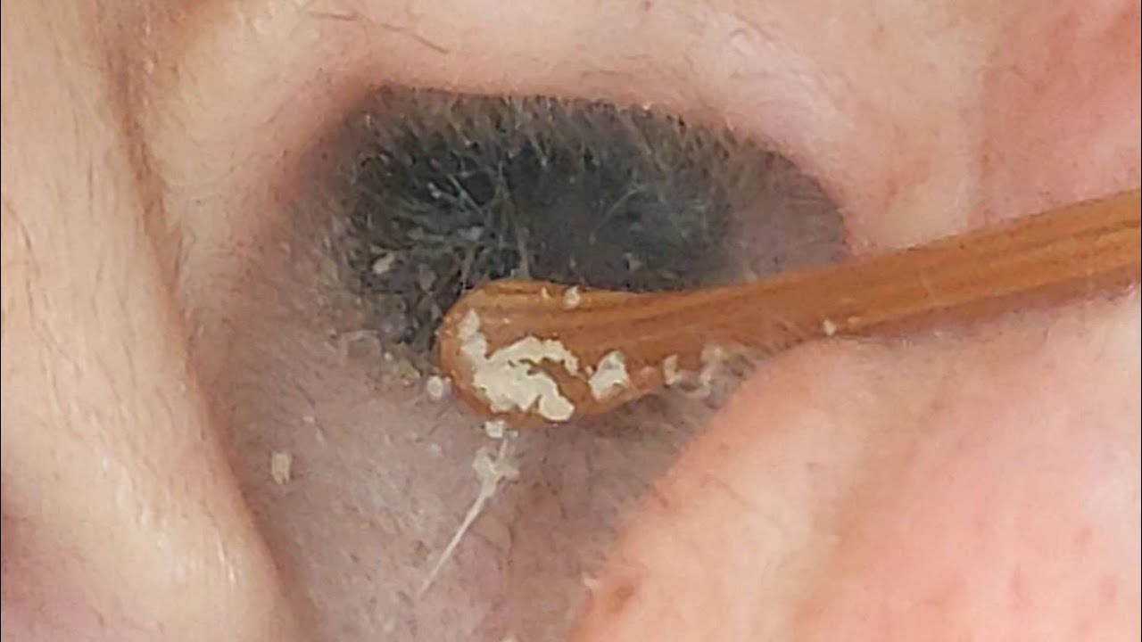 【耳掃除】#160  〜毛、長すぎ（笑）〜　earwax