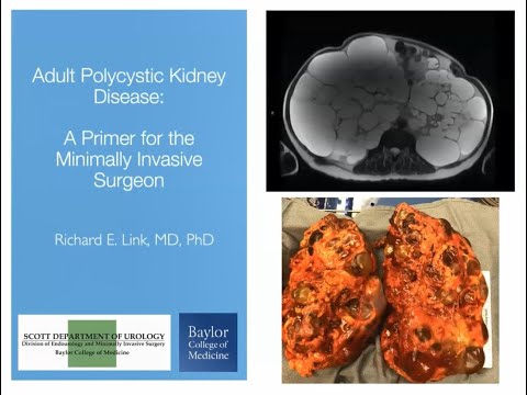4.23.2020 Urology COViD Didactics - Adult Polycystic Kidney Disease