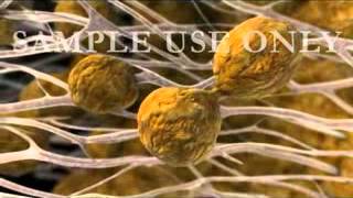 Arteriosclerosis Medical Animation