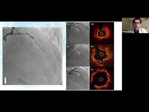Intravascular Lithotripsy for Treatment of Calcified Coronary Lesions