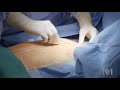Open Heart Surgery | Inside the OR